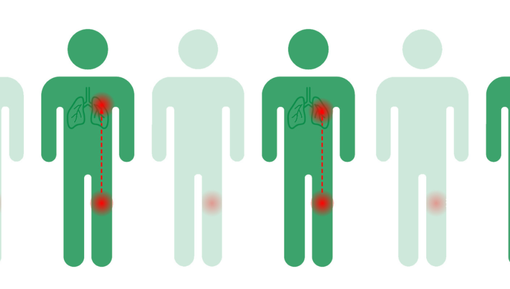 1 von 2 unbehandelten Thrombosen dehnen sich aus und können so zu einer Lungenembolie führen.