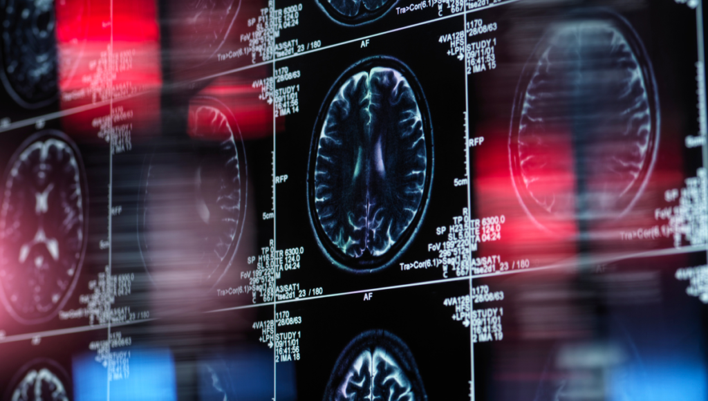 Scan-Aufnahme eines Gehirns in mehreren Schichten